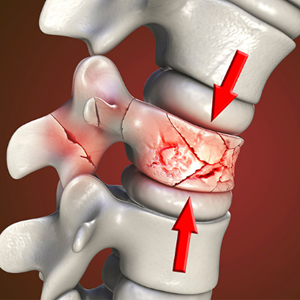 Chấn thương cột sống